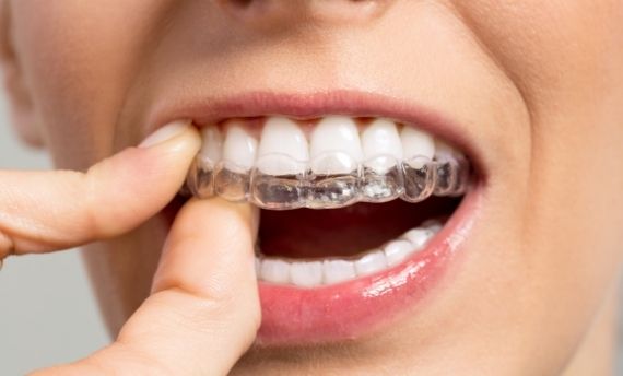 Denti Dritti con ortodonzia invisibile o classica - Ortodonzia Invisalign  Bologna